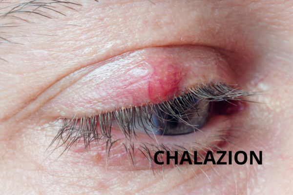 Le Chalazion